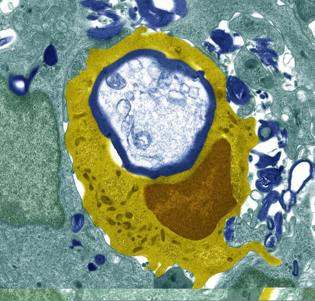 Macrophage engulfing a nerve cell,TEM