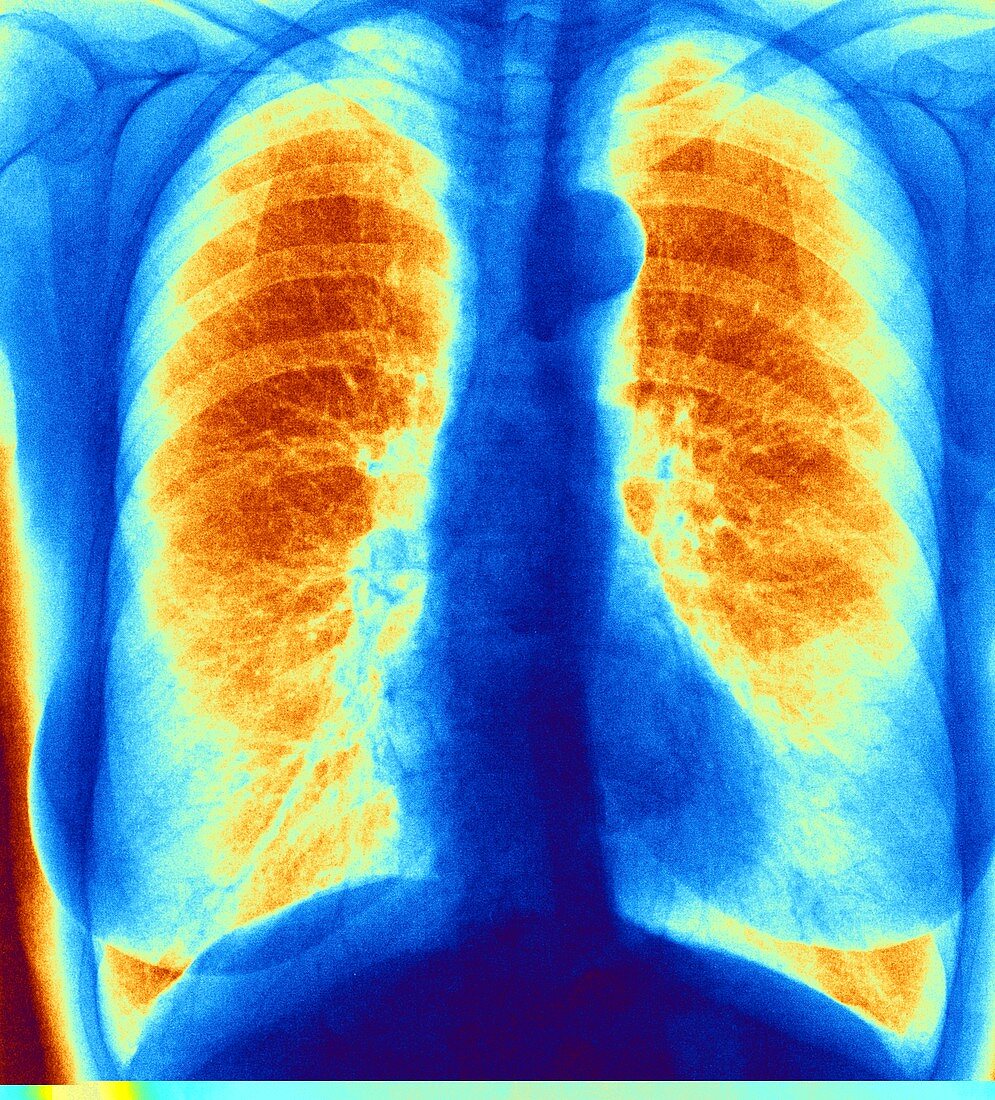 Normal chest,coloured x-ray