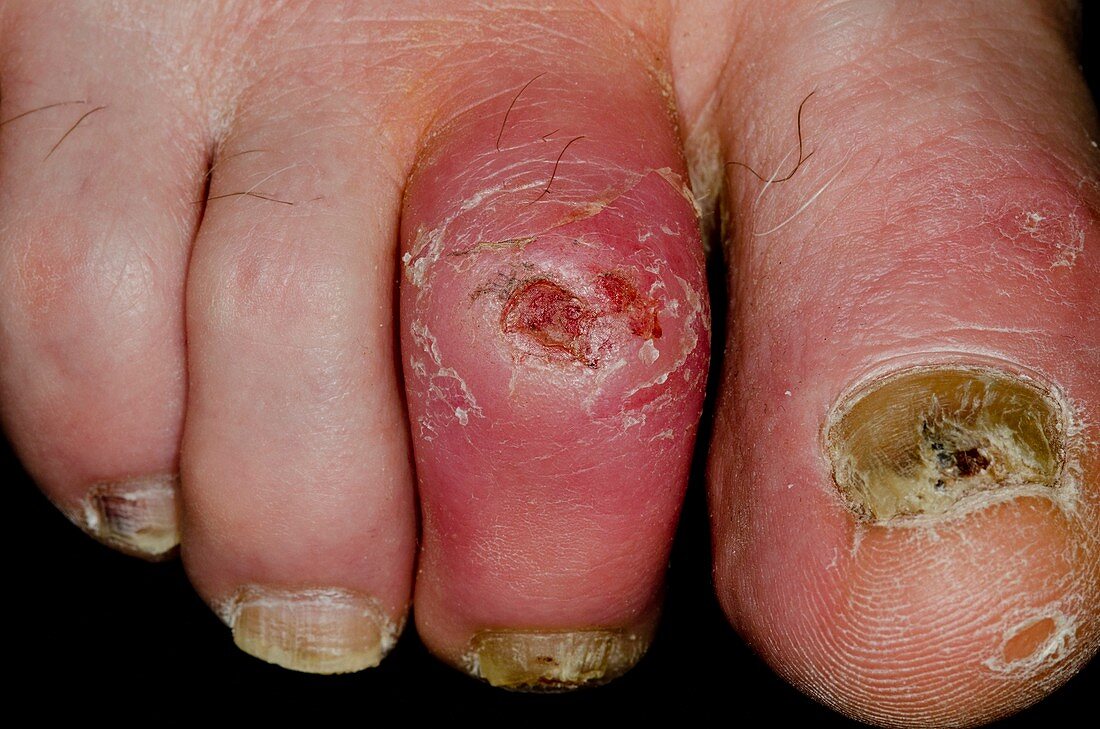 Infected toe ulcer