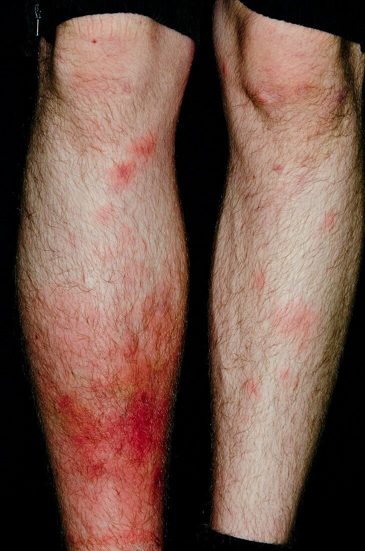 Cellulitis of the leg after insect bites