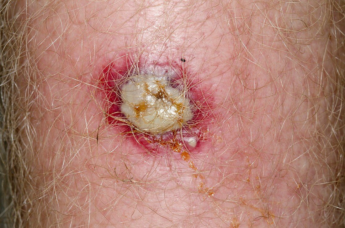 Infected wound from leech bite