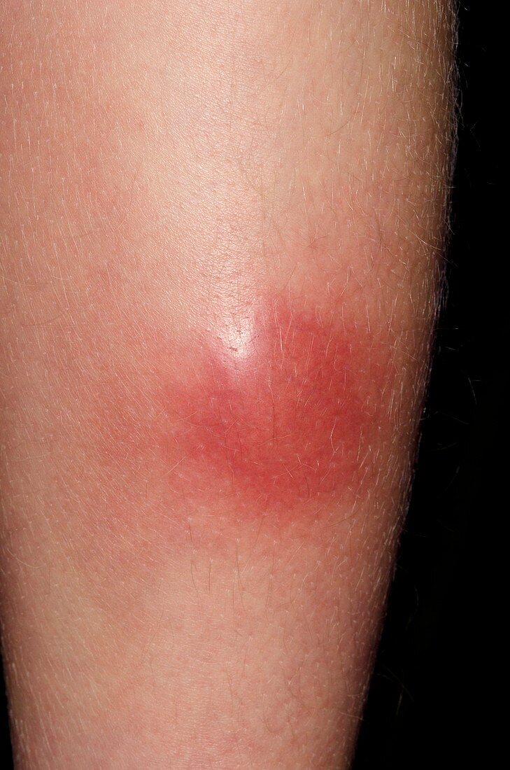 Abscess on leg following insect bite
