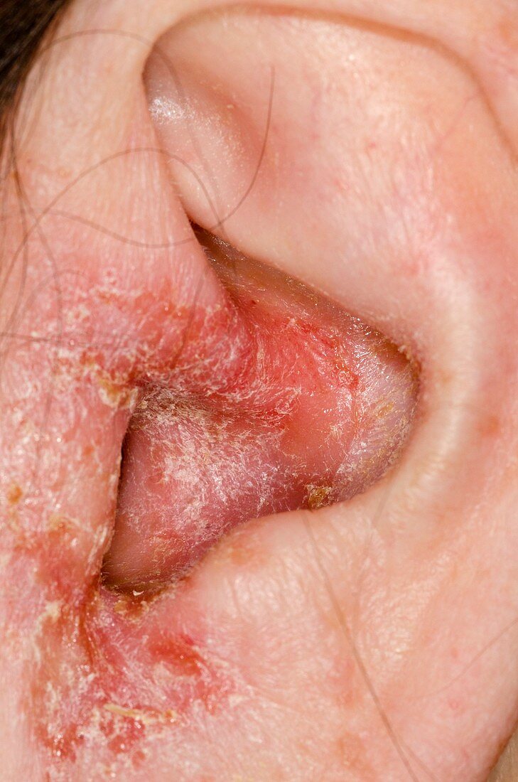 Infected outer ear