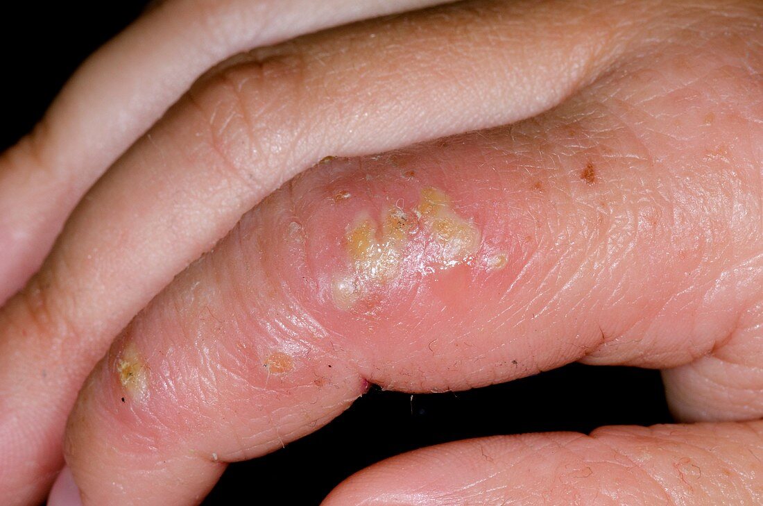 Infected eczema on the finger