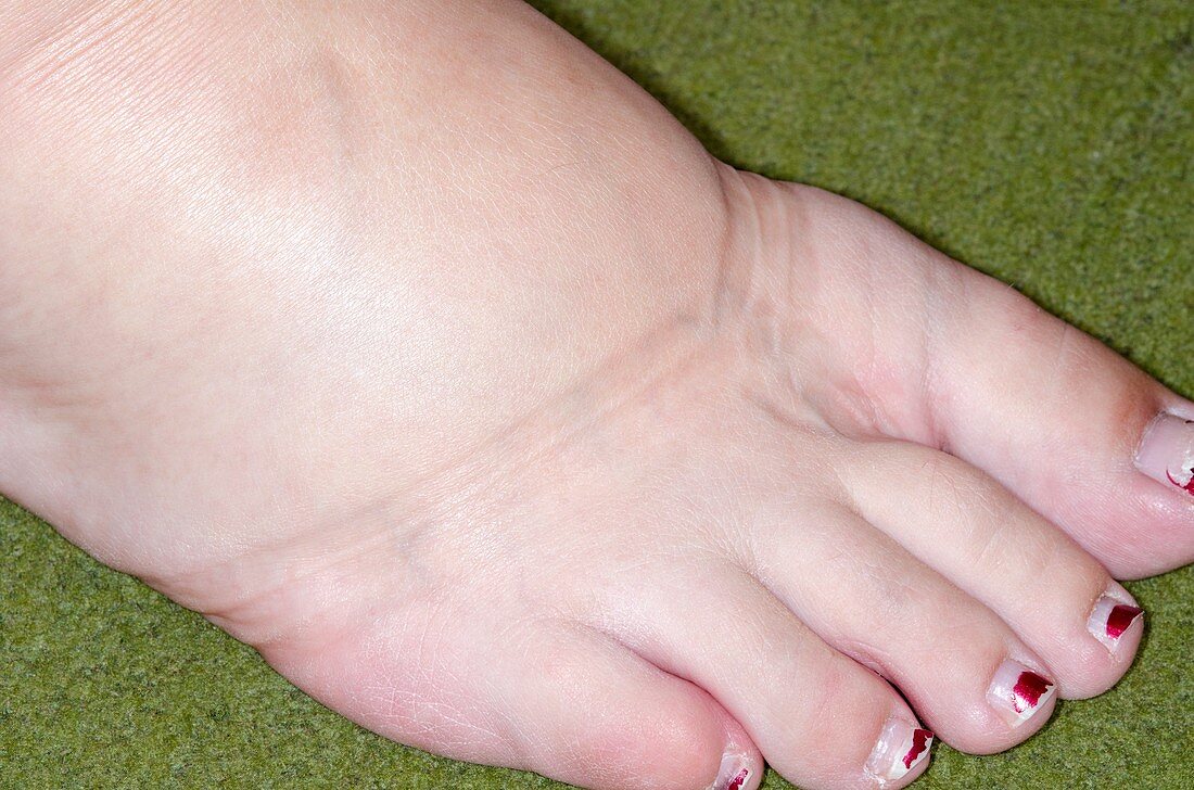 Foot swelling in late pregnancy