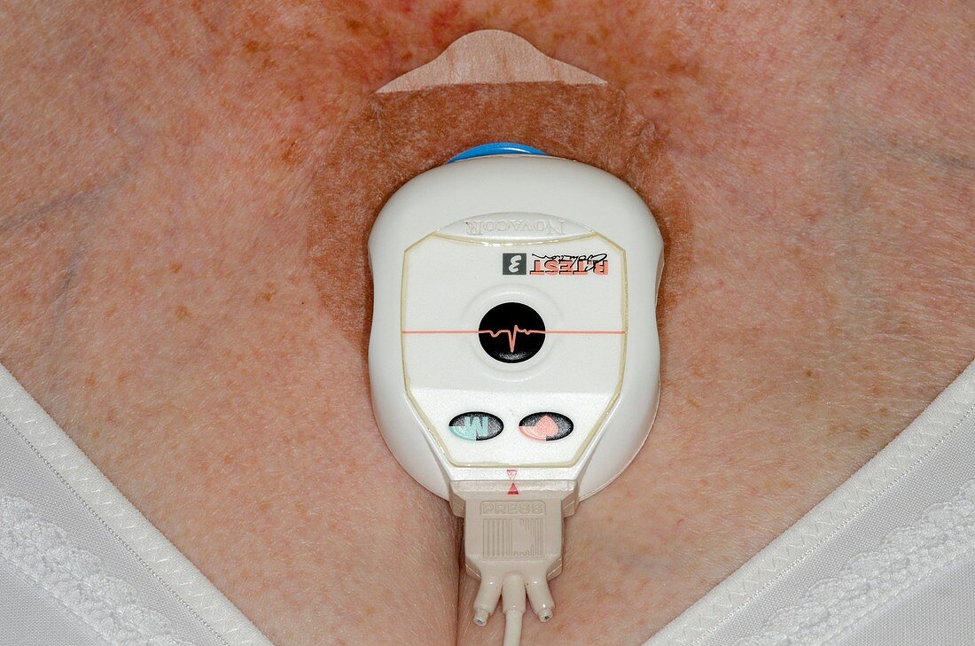 Novacor heart monitor on patient