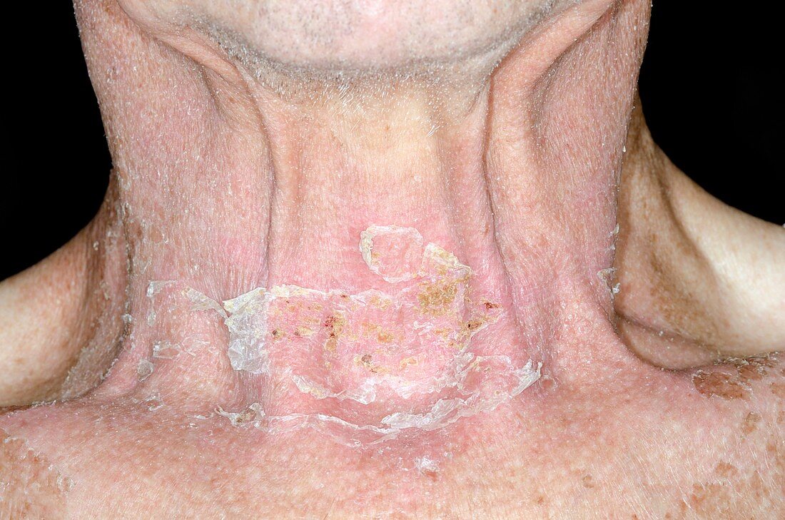 Skin damage after radiotherapy