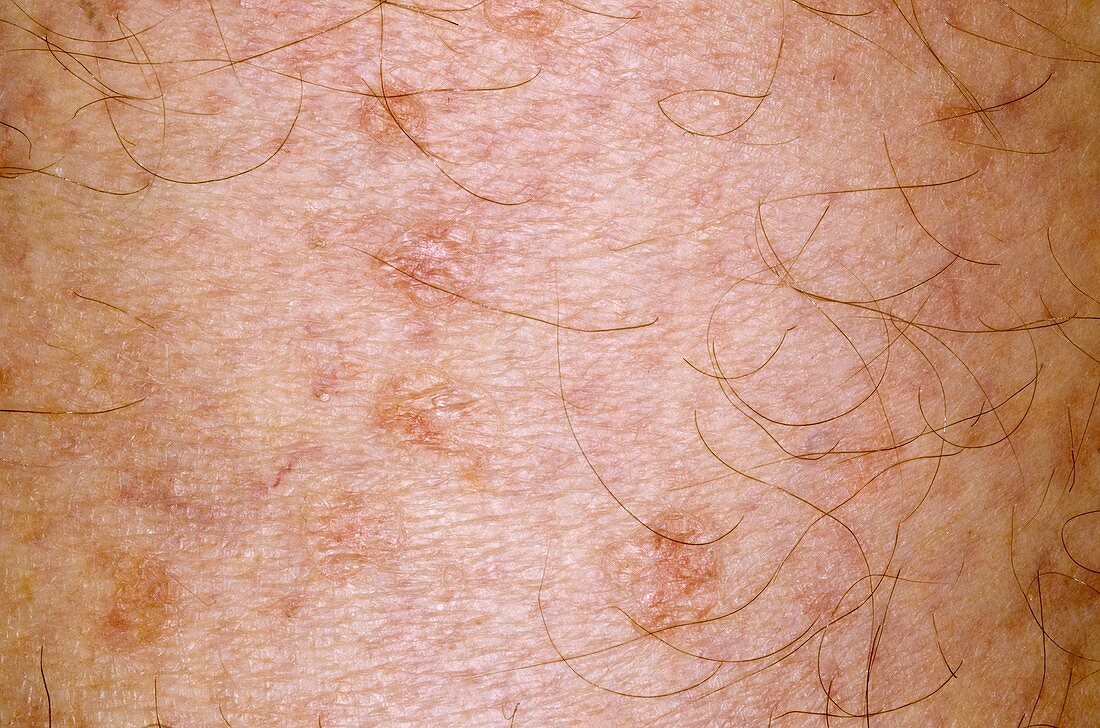 Skin rash after methotrexate drug