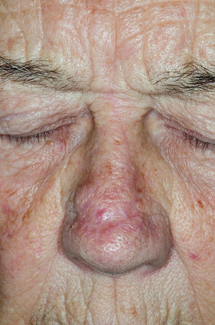 Skin cancer surgical scar on nose
