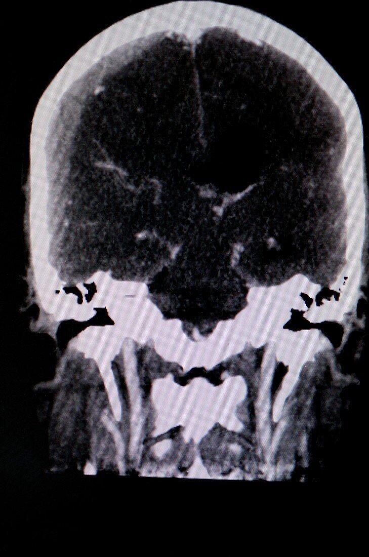 Subdural haematoma,CT scan