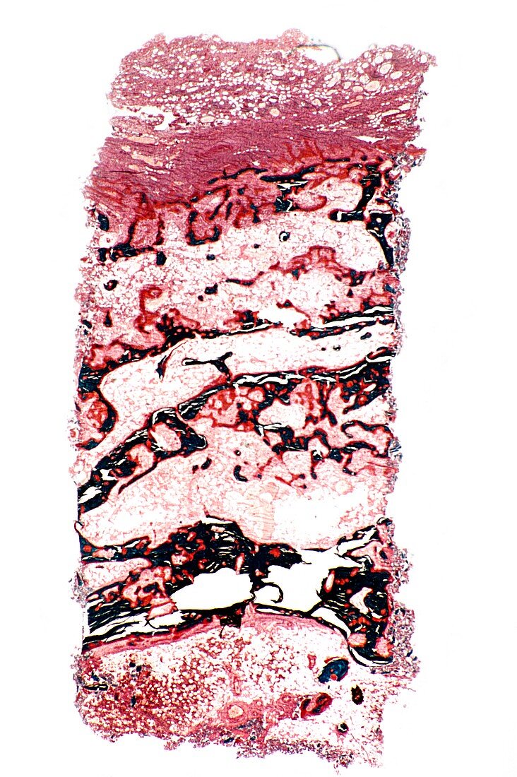 Rheumatoid arthritis,light micrograph