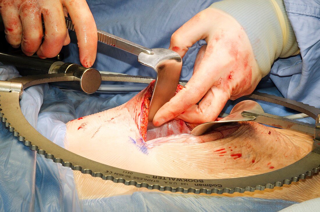 Pancreatectomy and splenectomy surgery