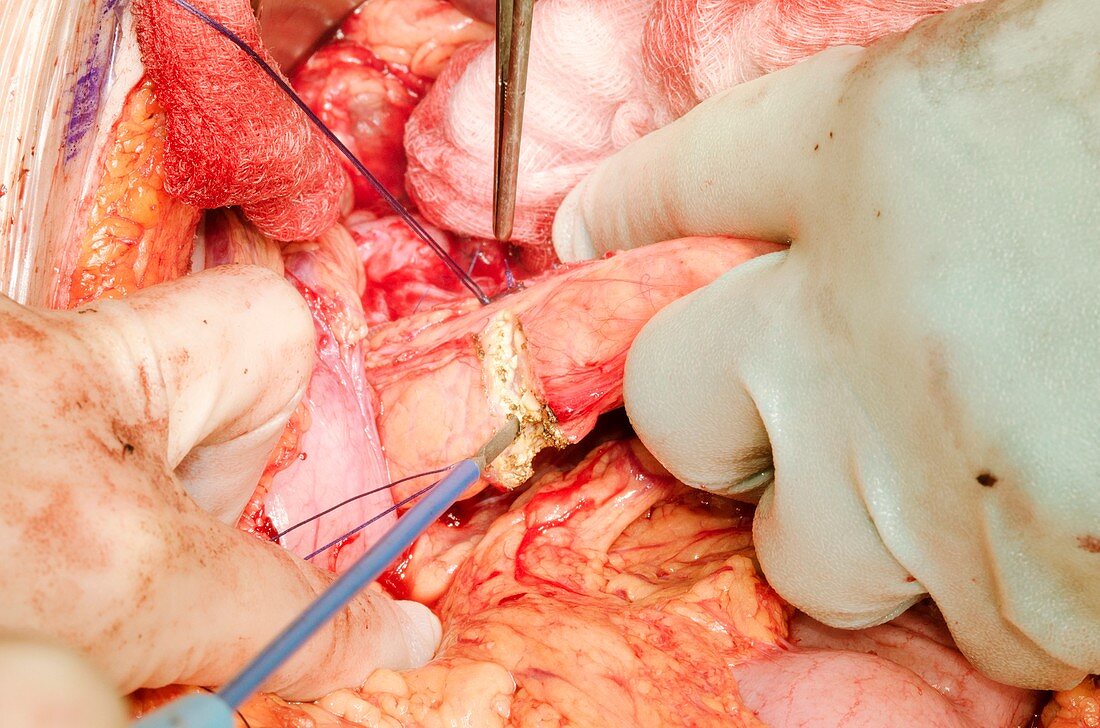 Pancreatectomy and splenectomy surgery