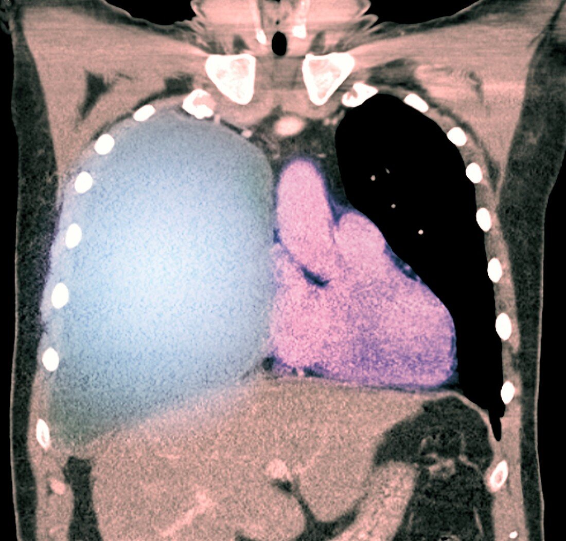 Pleural effusion in mesothelioma,CT scan