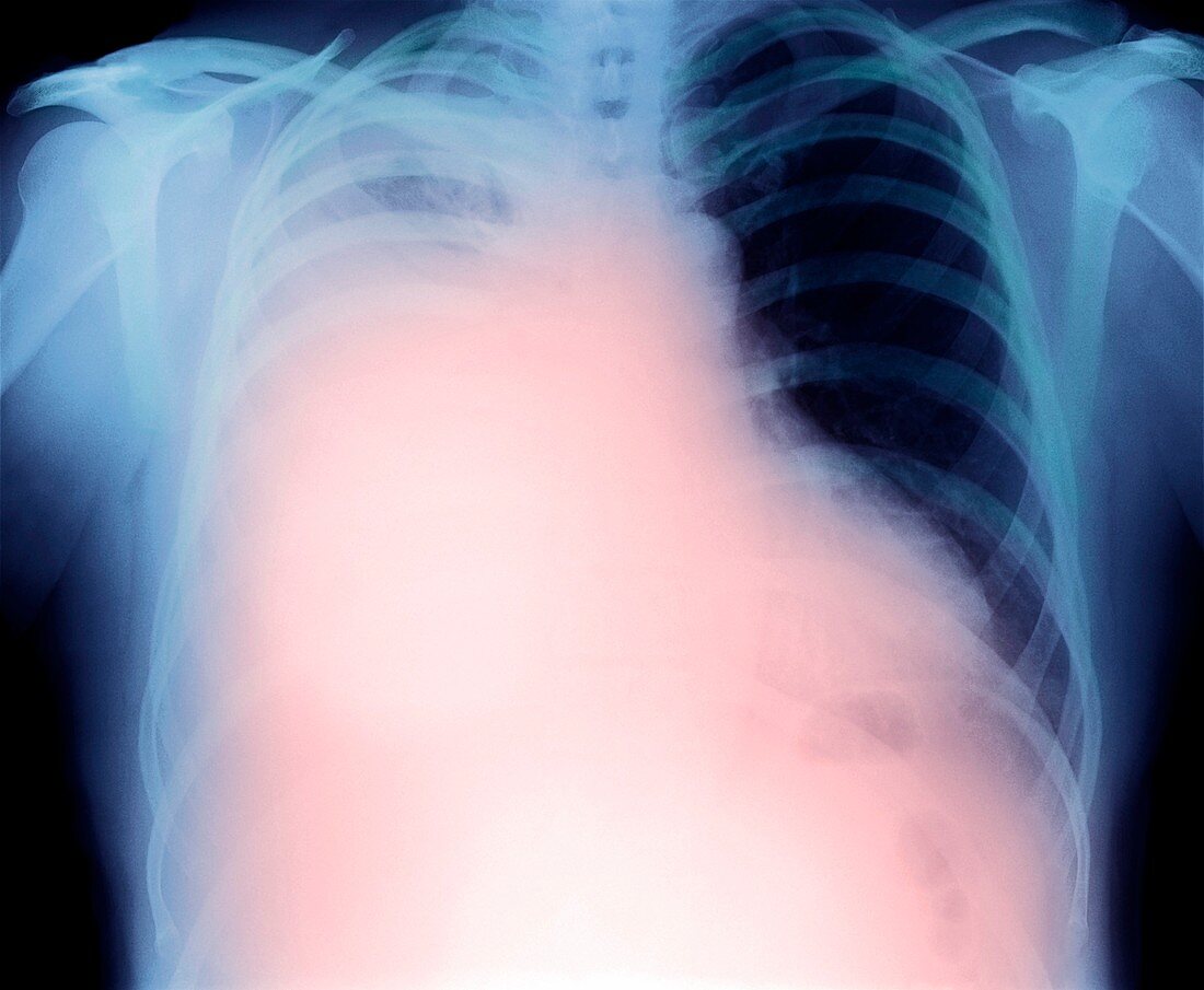 Pleural effusion in mesothelioma,X-ray