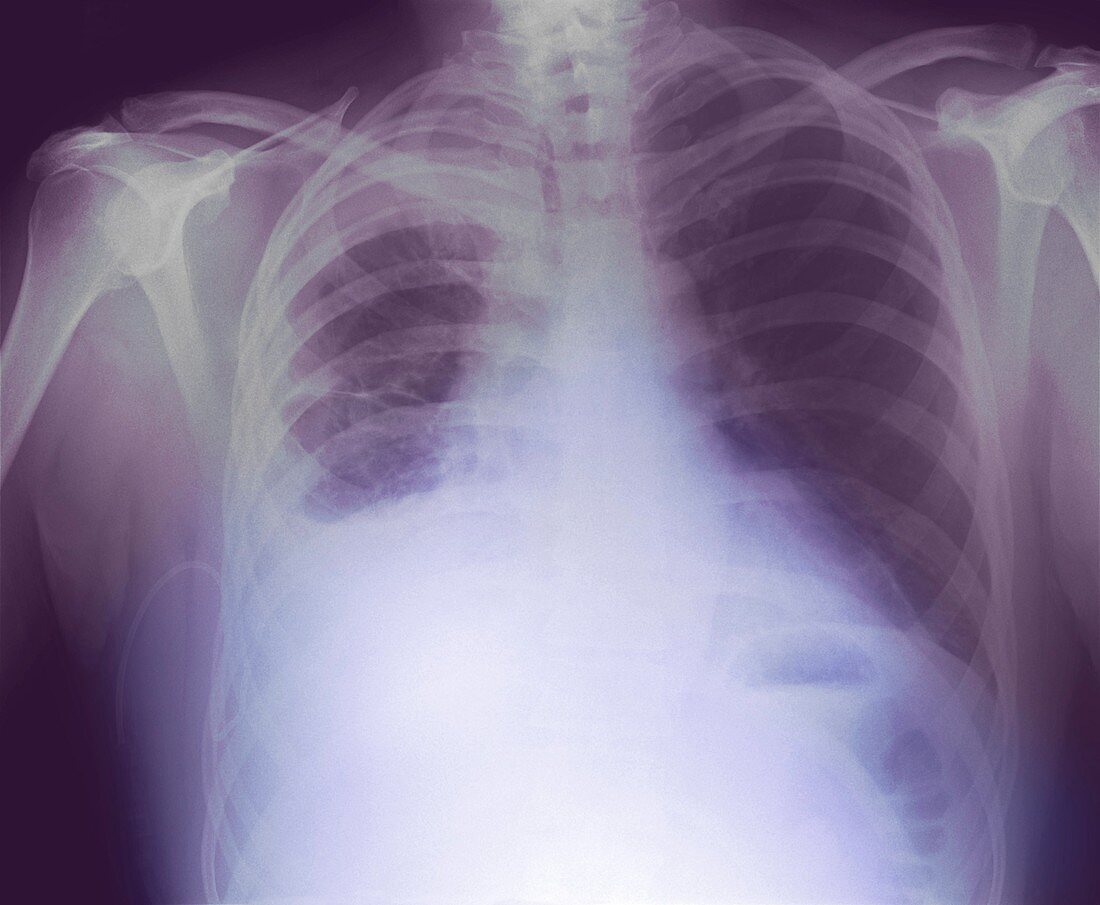 Drained pleural effusion,X-ray