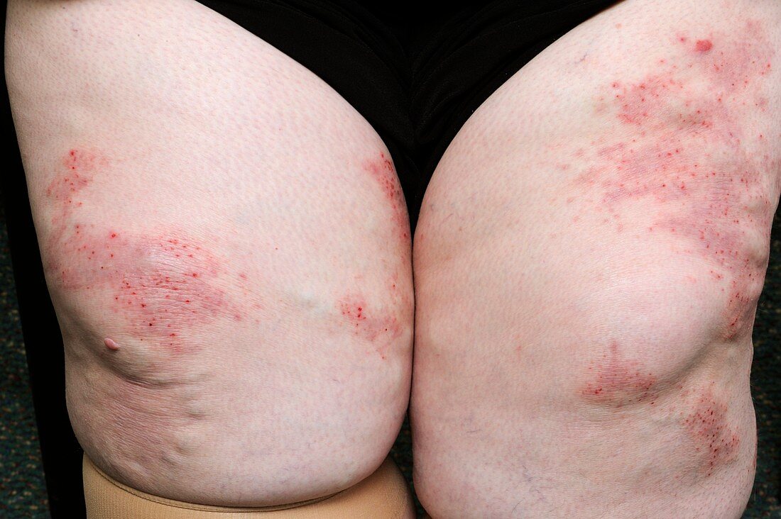 Eczema on legs of obese patient