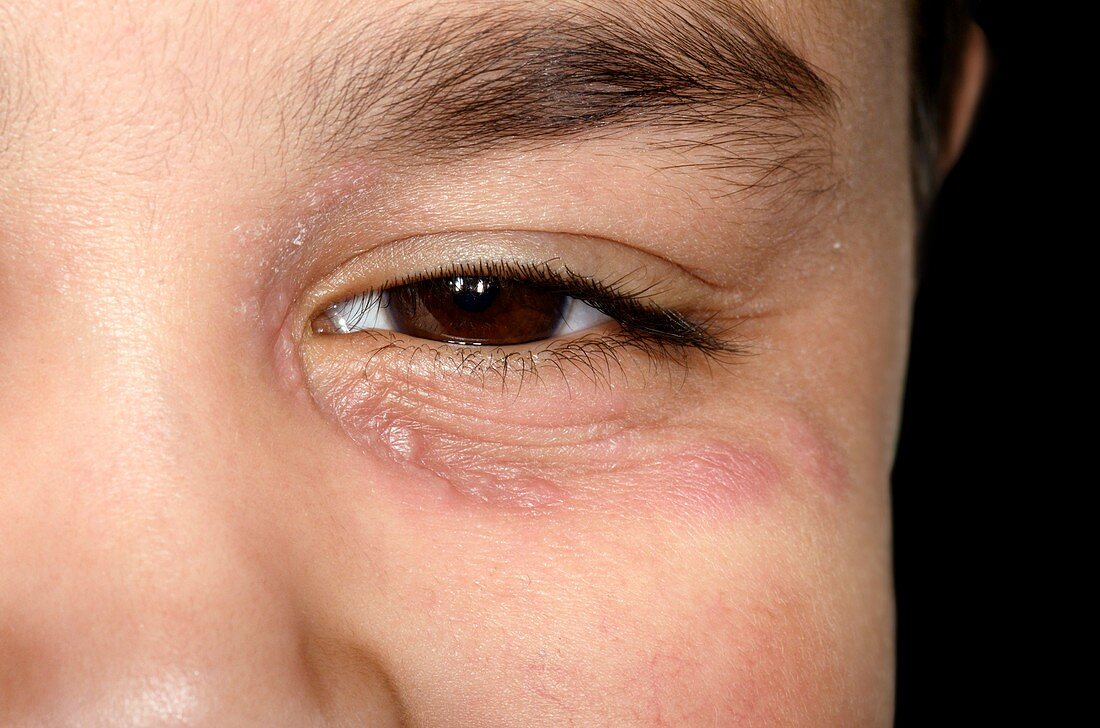 Herpes infection around the eye