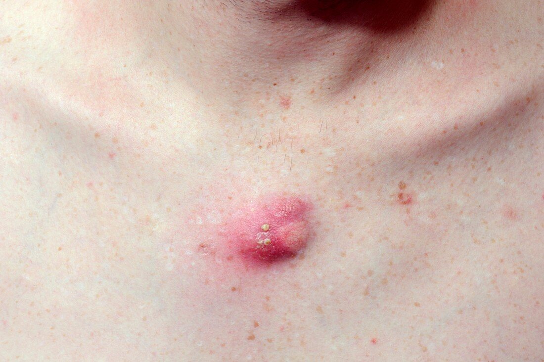 Infected cyst on the chest