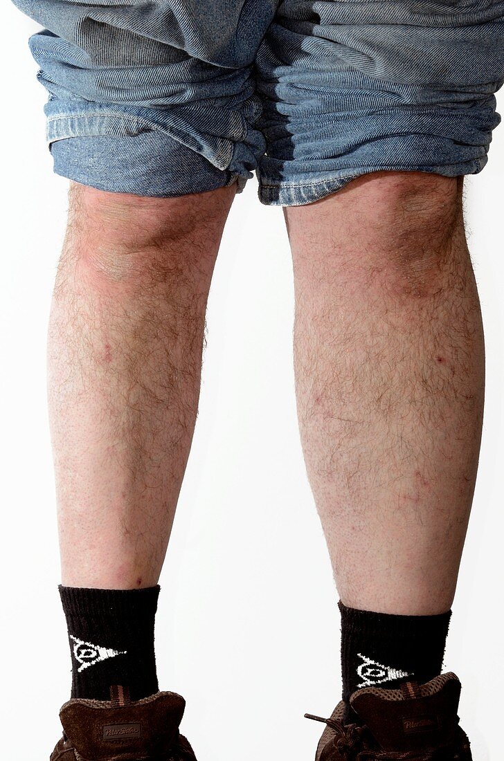Muscle wasting in the lower leg