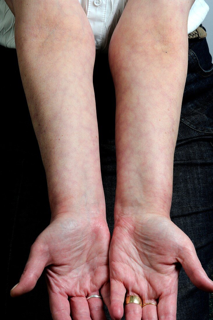 Livedo reticularis in the arms