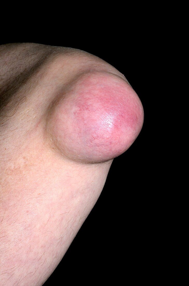 Bursitis of the elbow