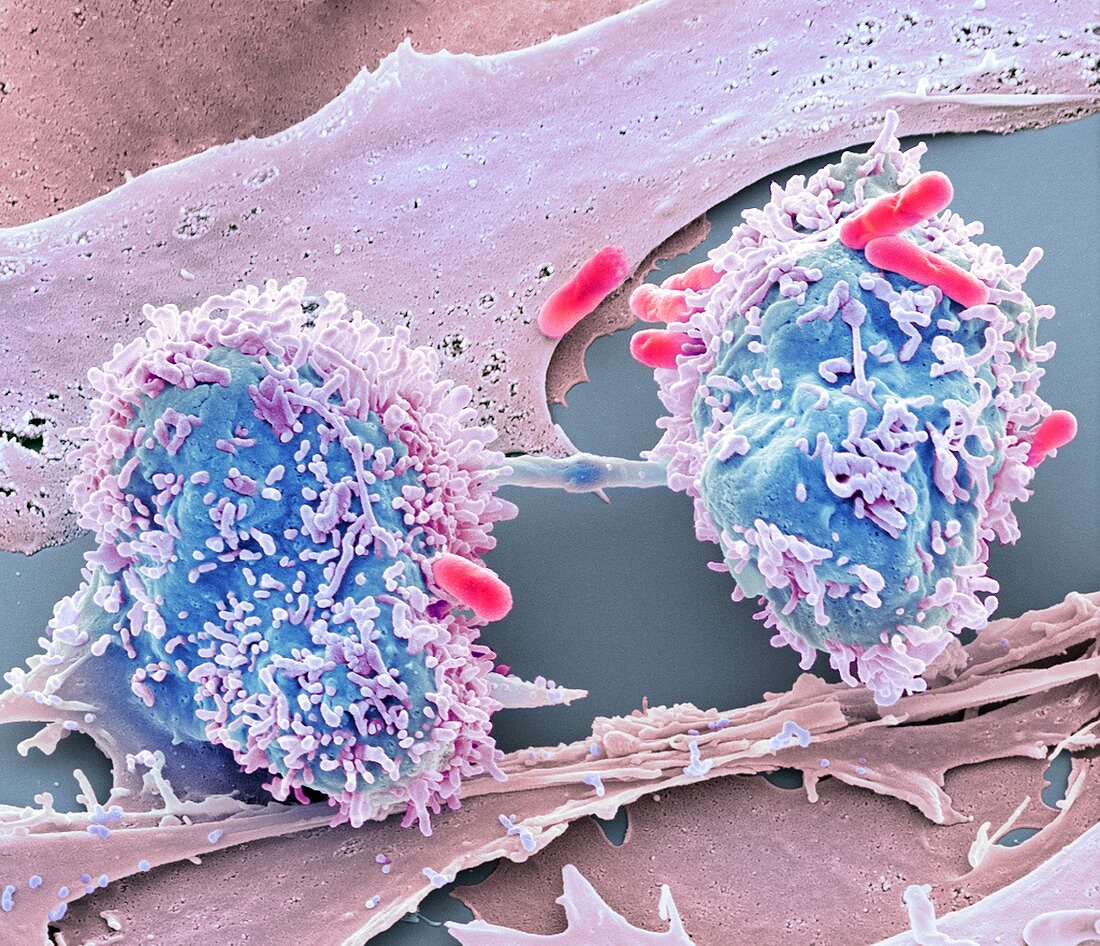 Dividing cancer cell,SEM