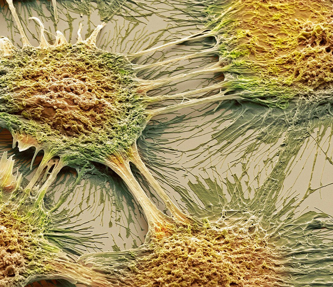 Vaginal cancer cells,SEM