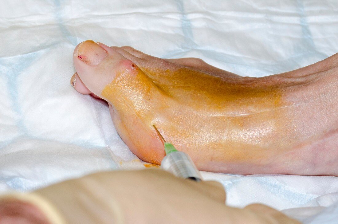 Foot surgery