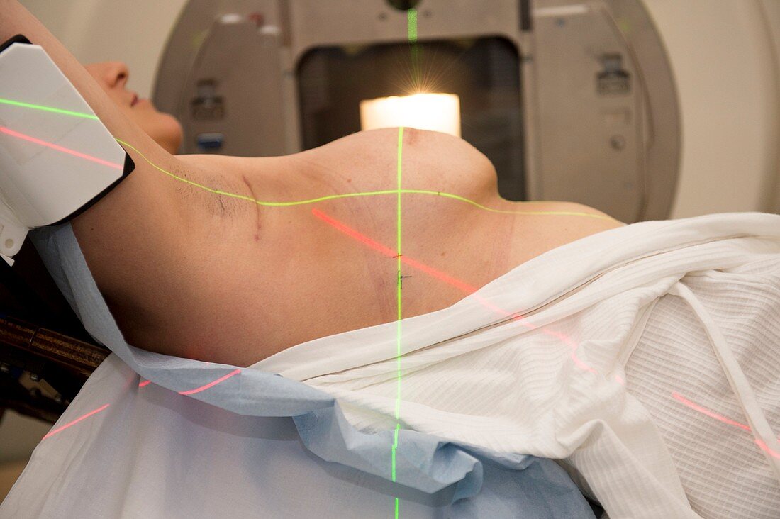 Breast cancer radiotherapy