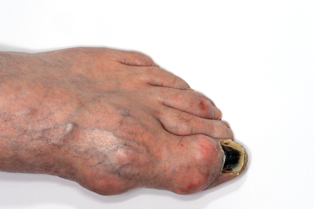 Gout in the large toe