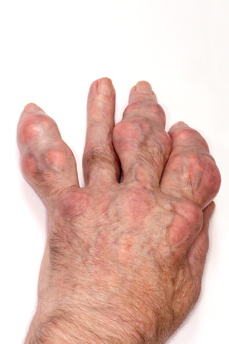 Gout in the fingers
