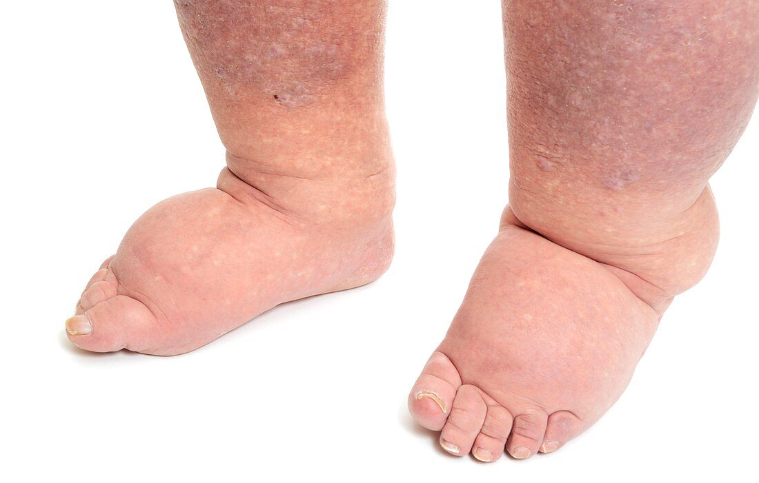 Lymphoedema in the feet