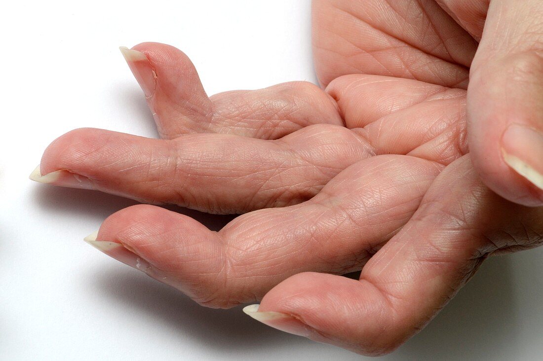 Rheumatoid arthritis of the fingers