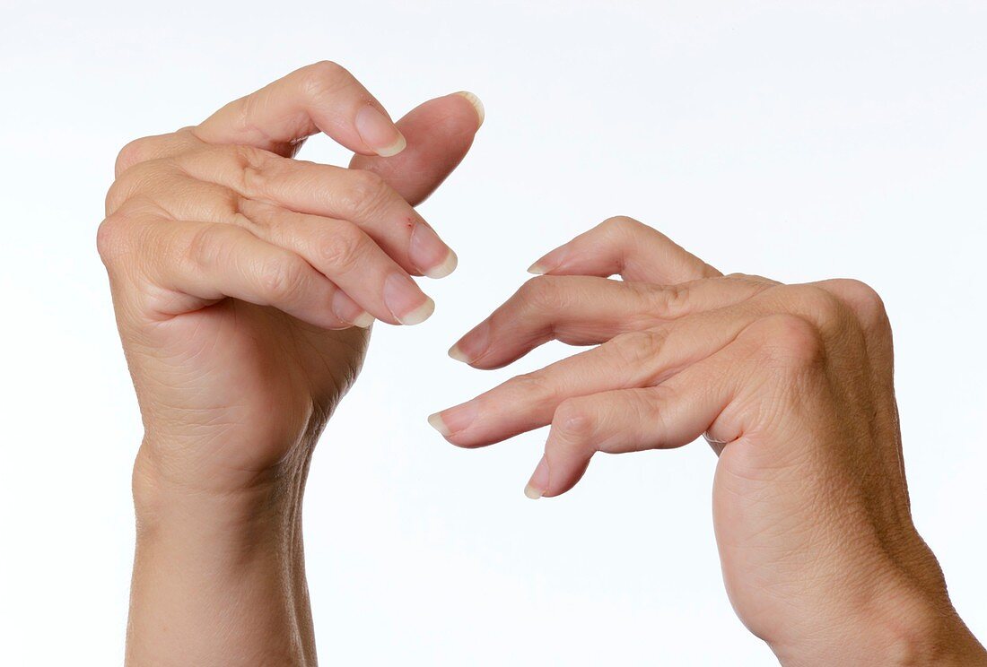 Rheumatoid arthritis of the fingers