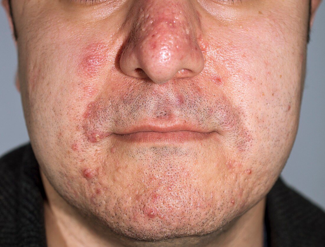 Acne pimples and scars