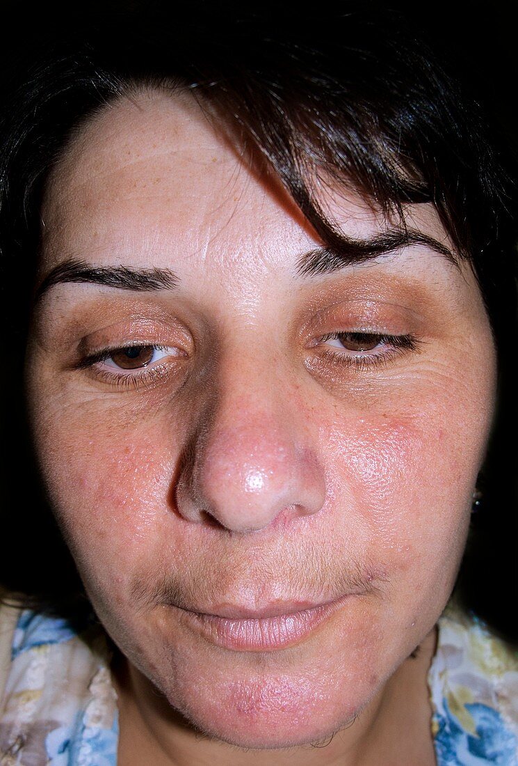 Acne rosacea after treatment