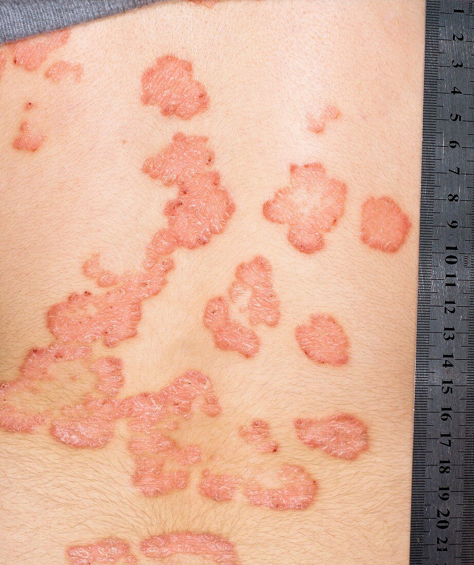 Psoriasis on the back during treatment