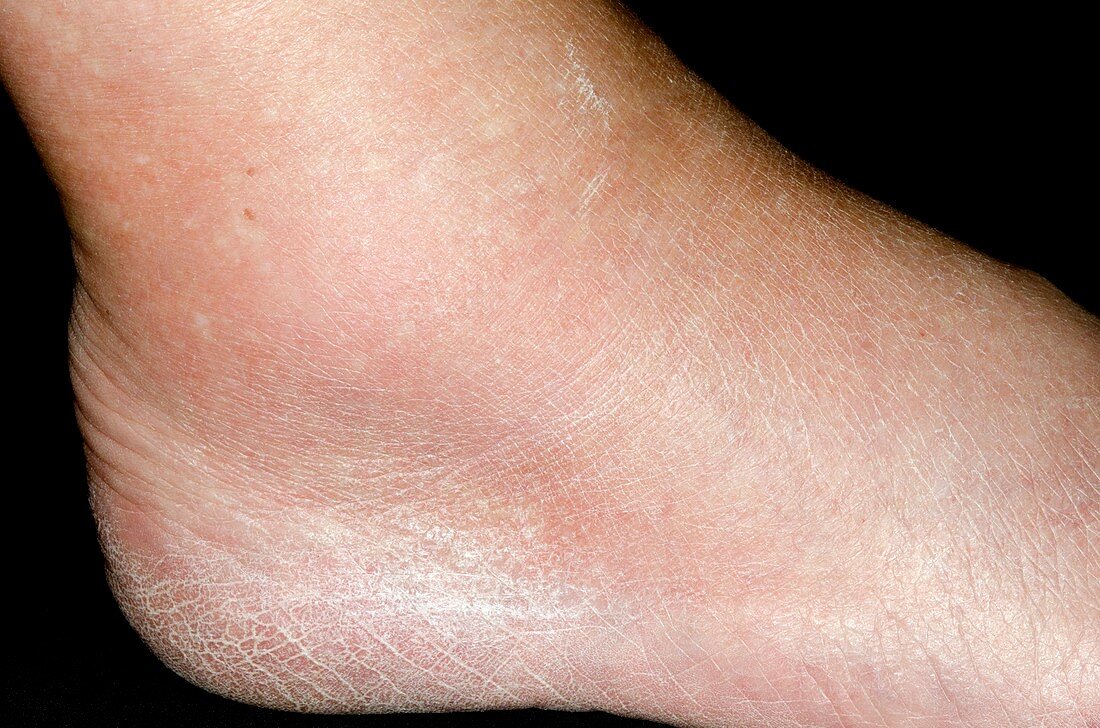 Gout in the ankle