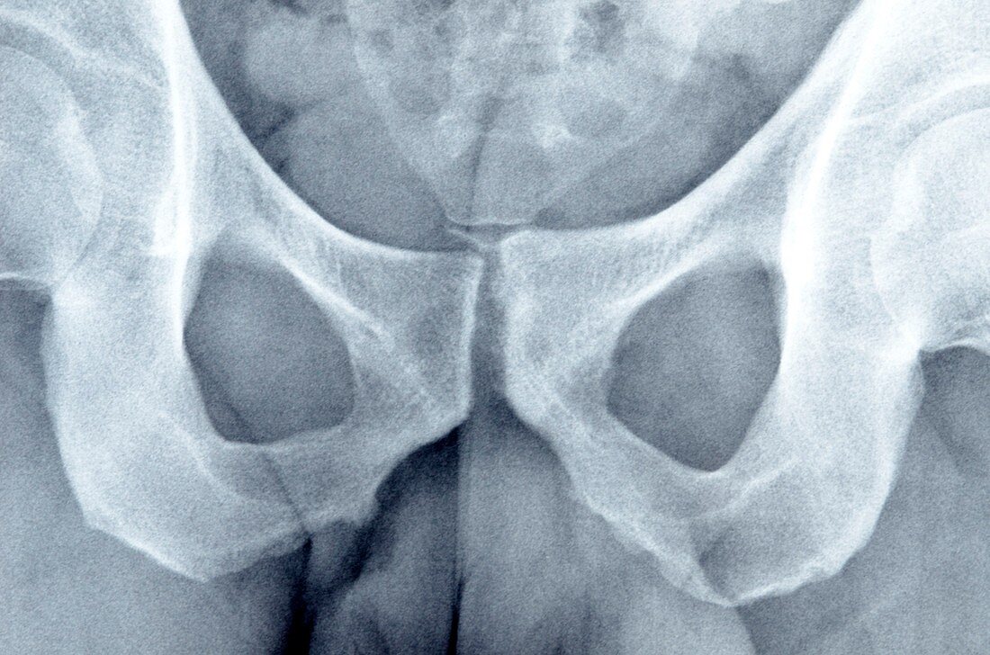 Misaligned pubic symphysis,X-ray