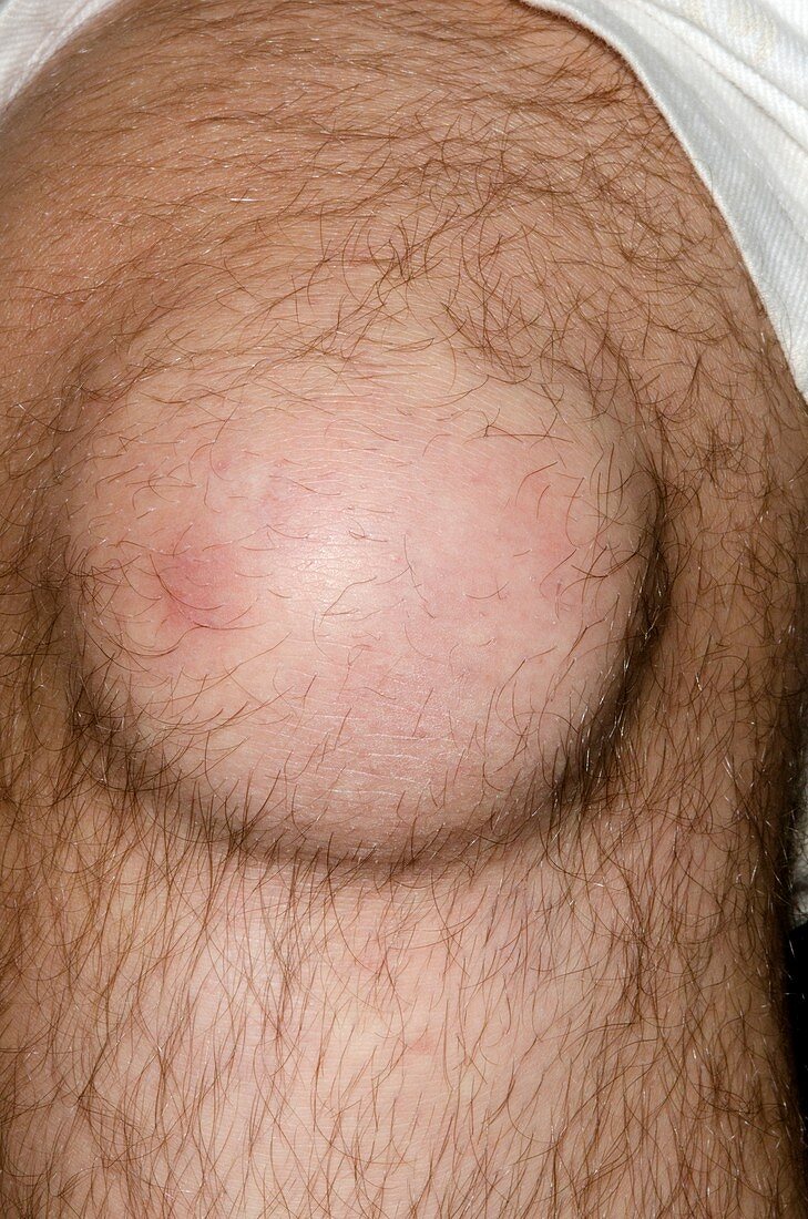 Bursitis of the knee