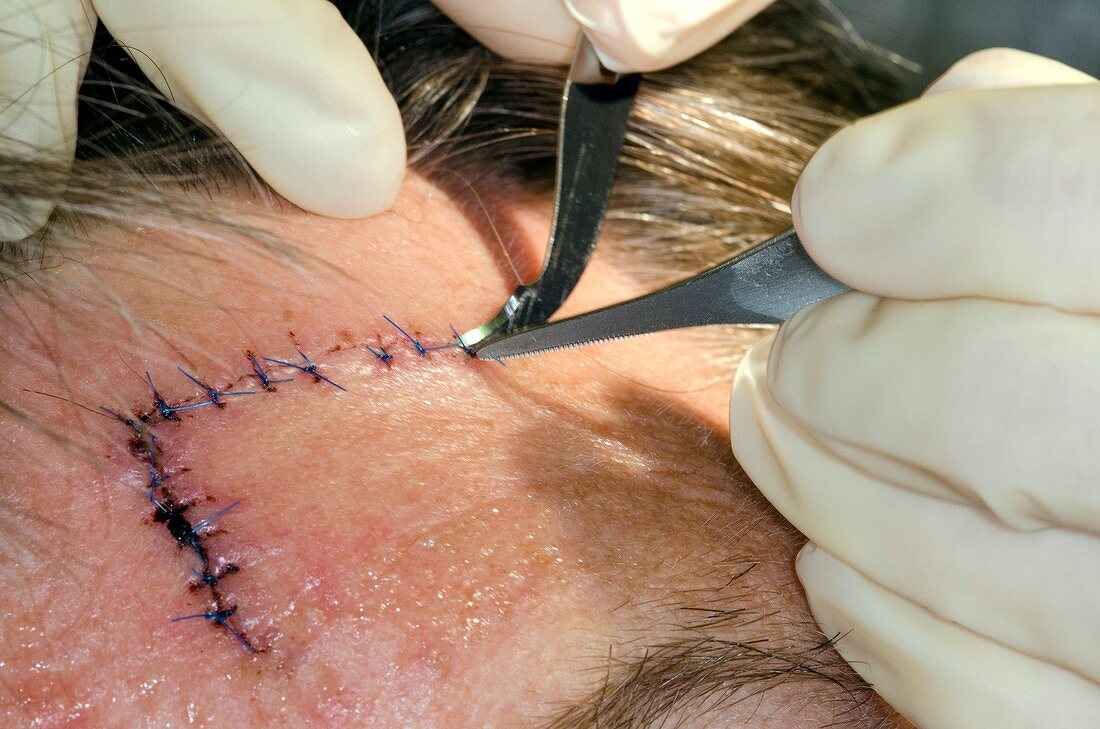 Removing sutures in the skin