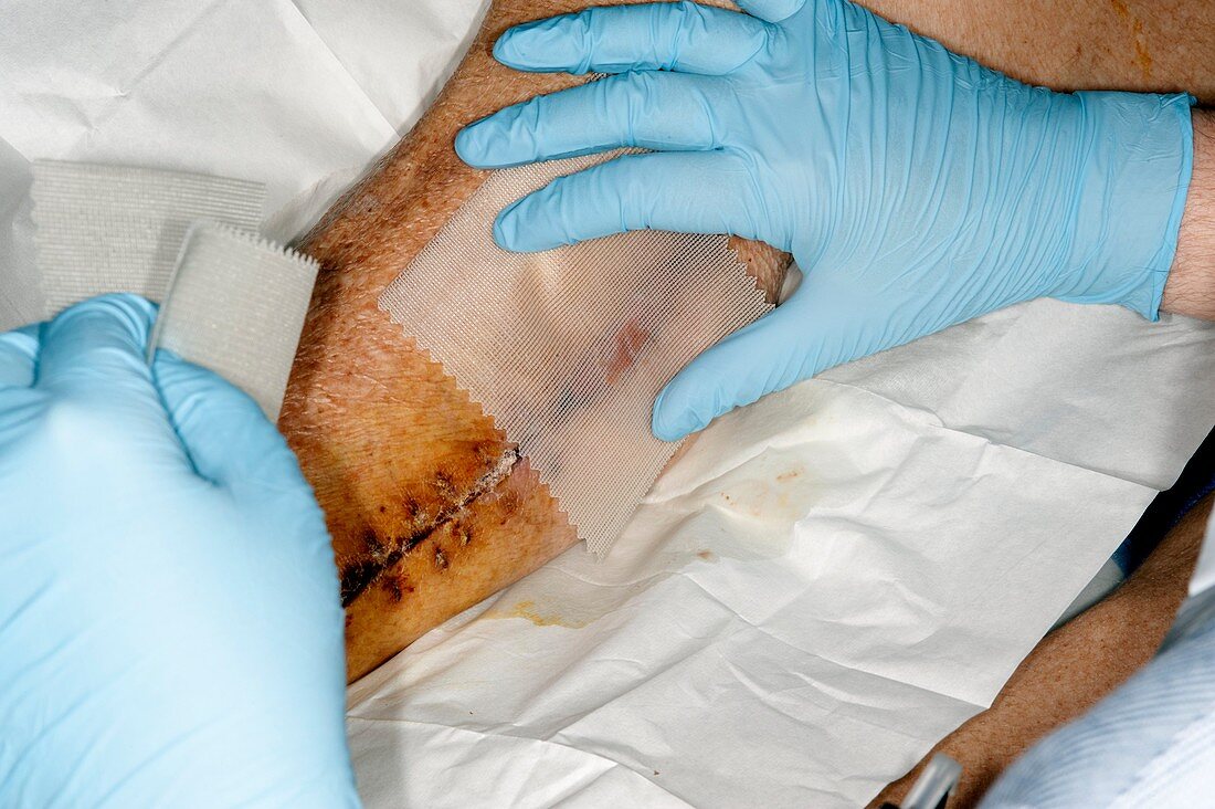 Calf wound healing after artery surgery