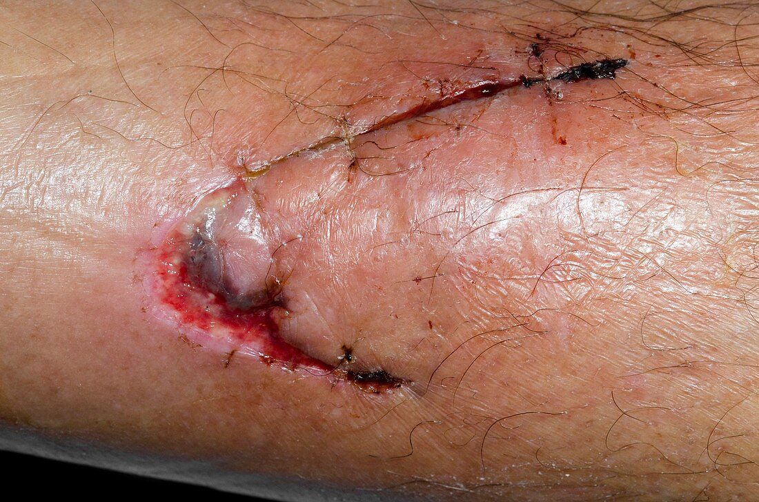 Infected laceration of the shin