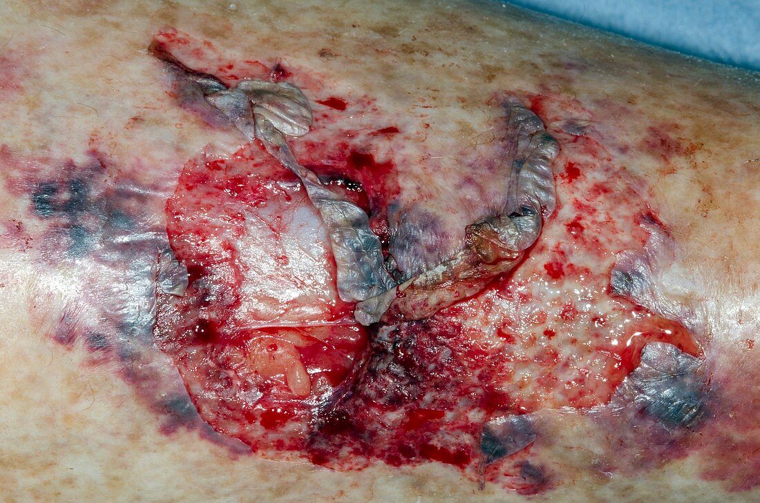 Laceration on the shin from injury