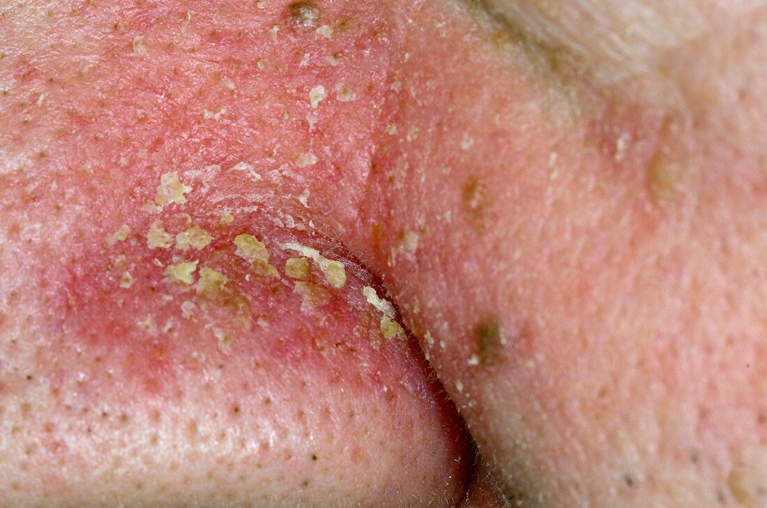 Seborrhoeic dermatitis on the nose