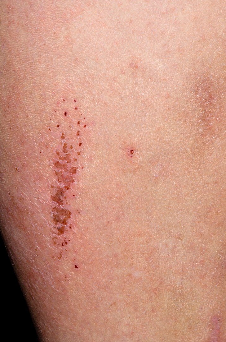 Allergic skin reaction to shin pads
