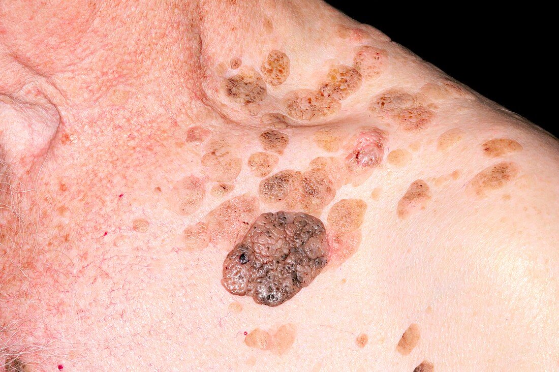 Seborrhoeic warts on the skin