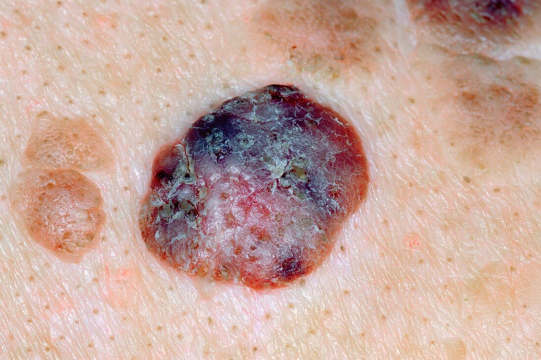 Seborrhoeic warts on the skin