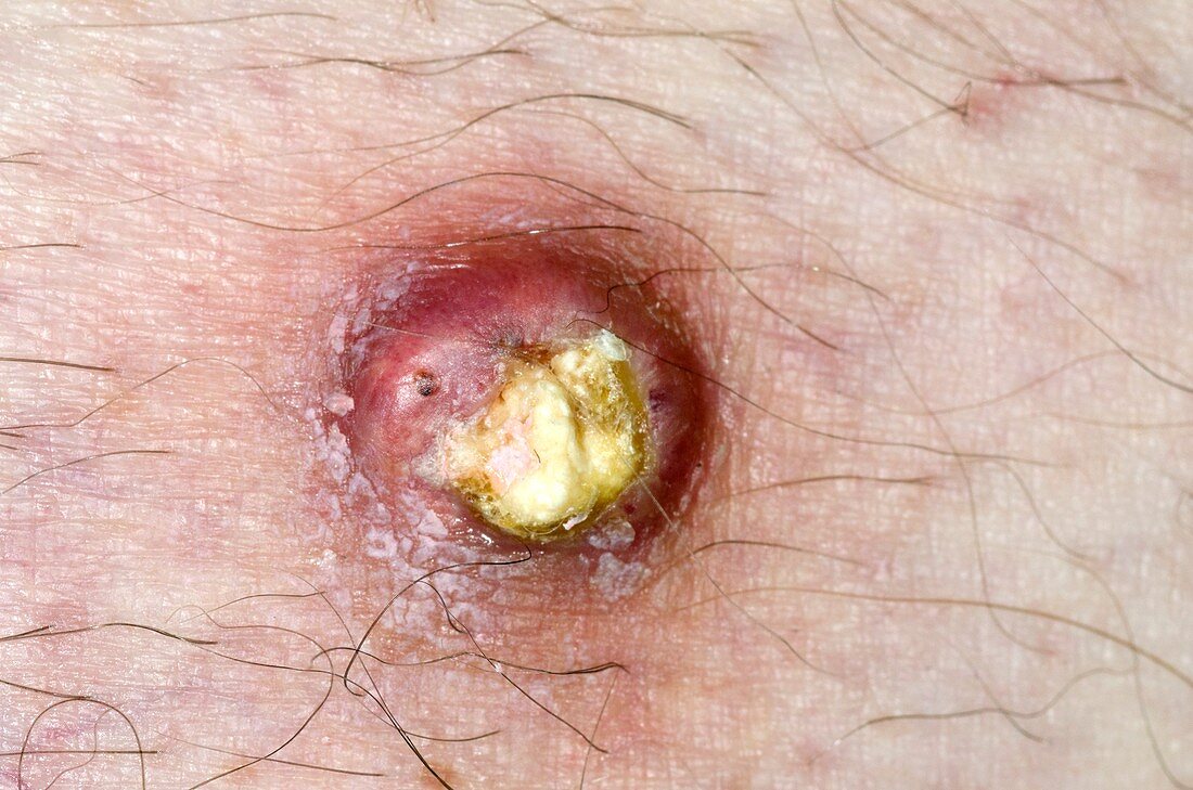 Calcified epidermoid cyst on the skin